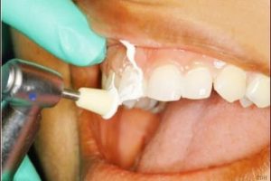 خلطات طبيعية لإزالة ترسبات الأسنان في وقت قصير