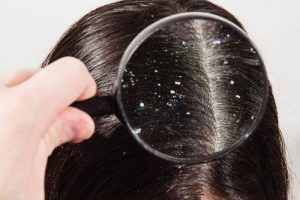 وصفات طبيعية لعلاج قشرة الشعر في وقت قصير